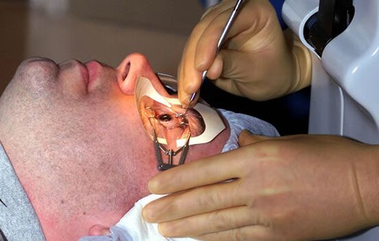 Scleroplasty for myopia to stabilize vision.